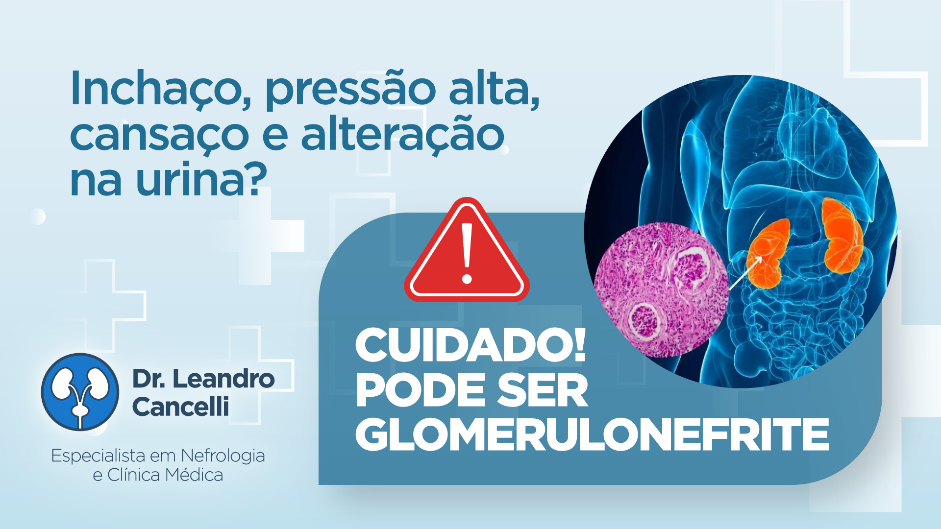 Glomerulonefrite: O Que É, Sintomas, Causas e Tratamentos